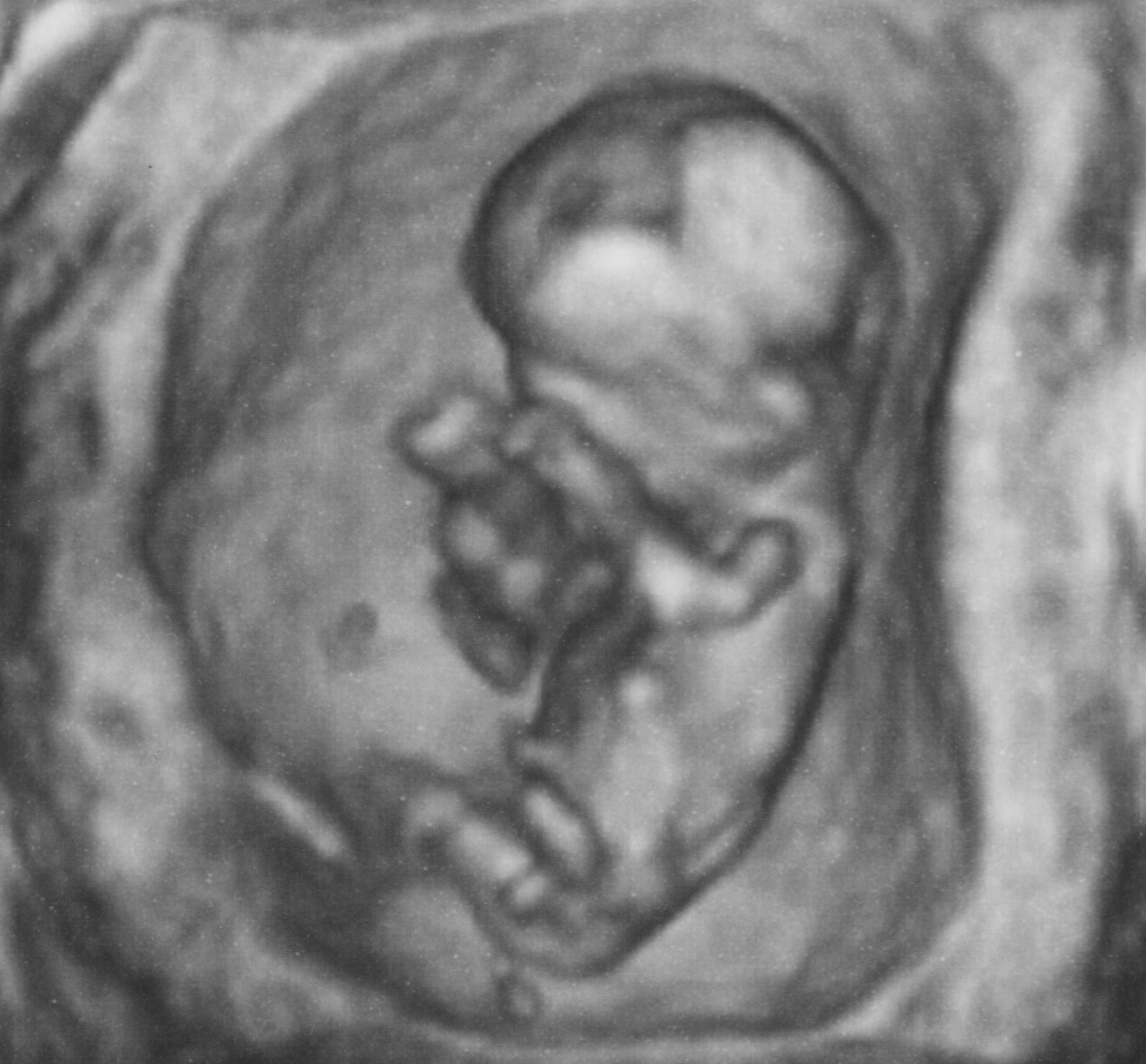 Ultrasound Week 12